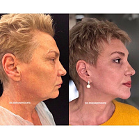 Результат пластической операции «Голливудский фейслифтинг»